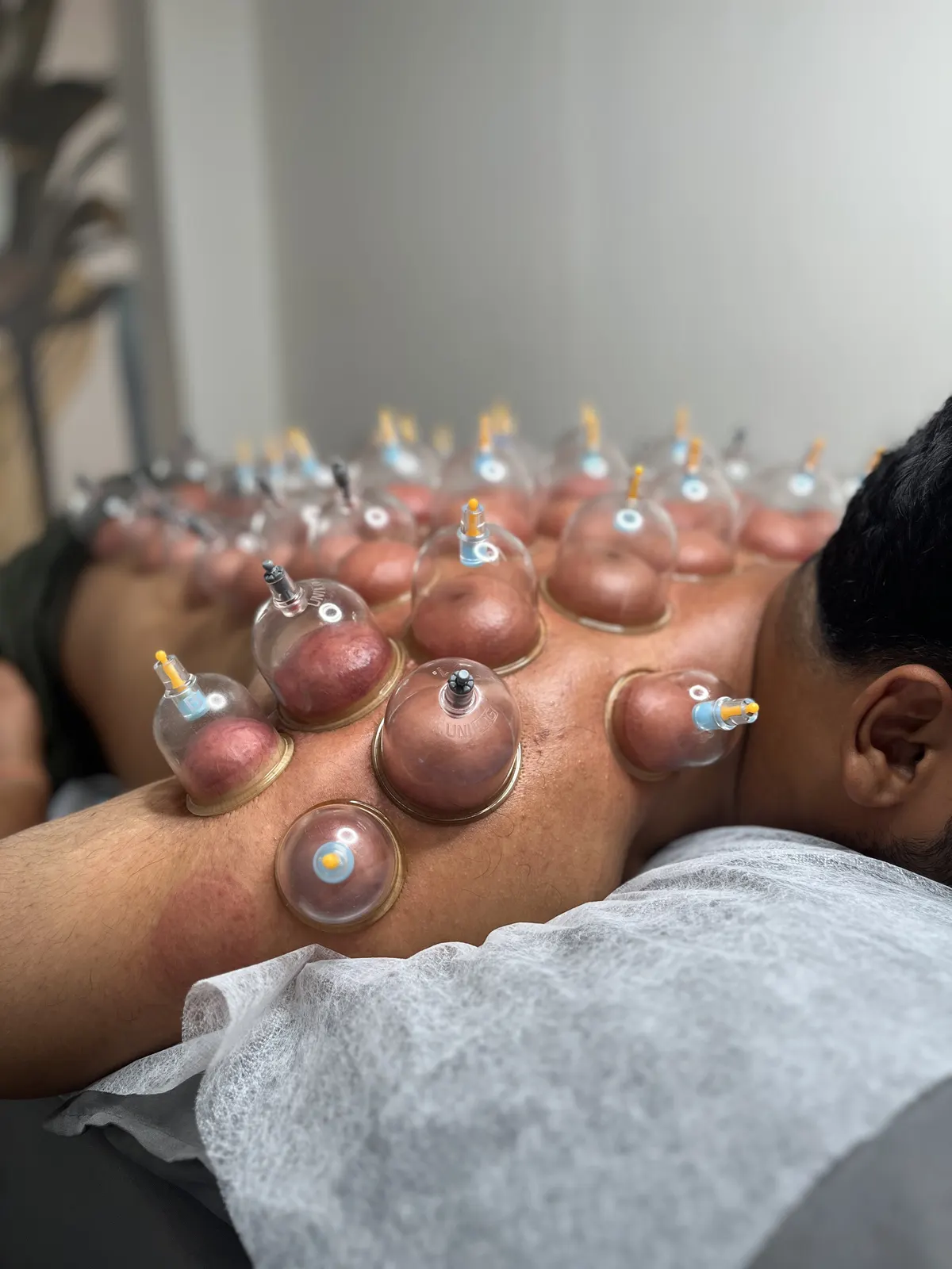 Rows of suction cups on a client's back and shoulder during a cupping session at Twelve Meridian