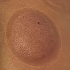 Light pink cup mark on a client's back after cupping