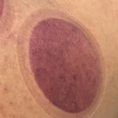 Red cup mark on a client's back after cupping