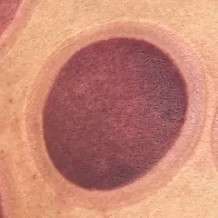 Deep red cup mark on a client's back after cupping