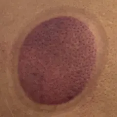 Purple cup mark on a client's back after cupping