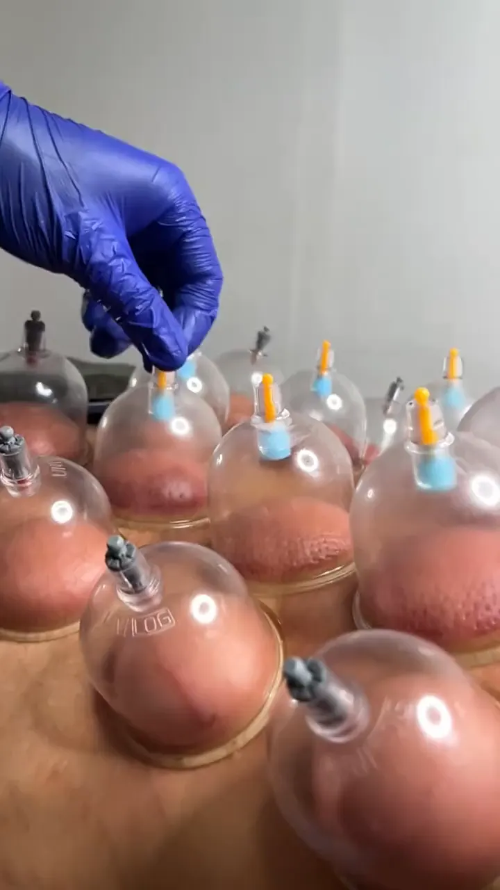 Rows of suction cups held in place on a client's back, with a gloved hand adjusting one