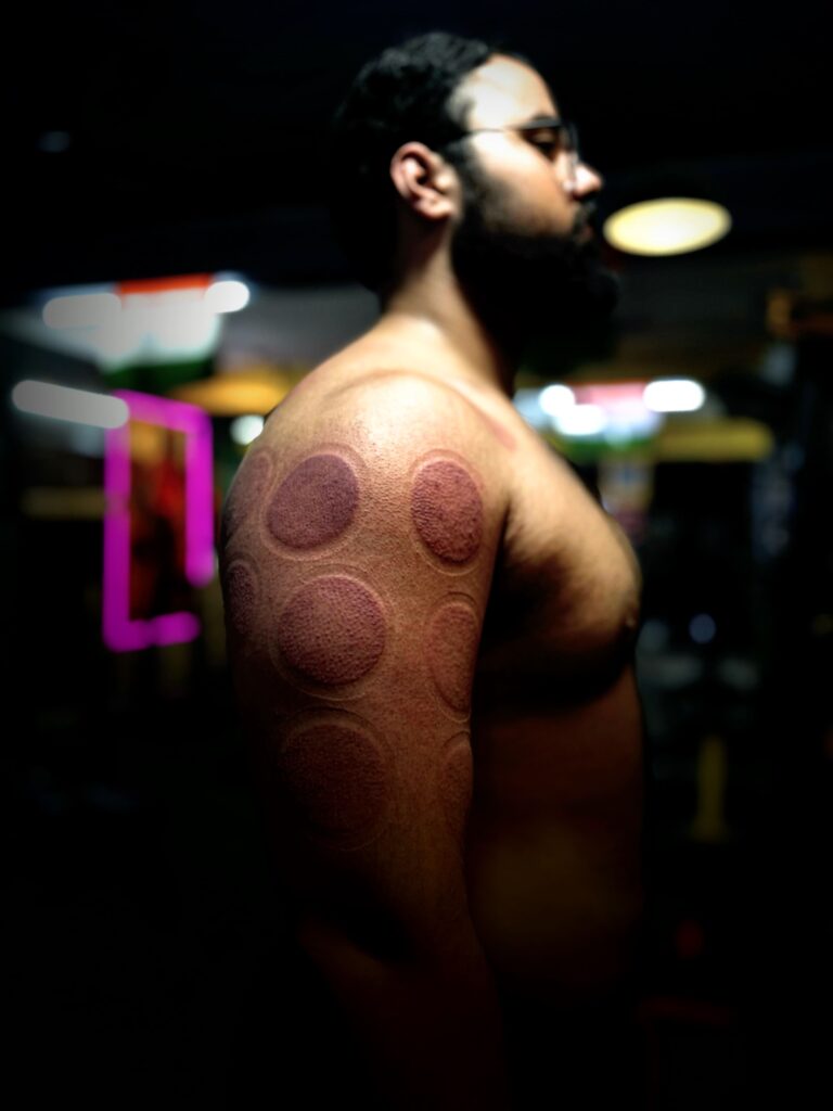 Twelve Meridian cupping therapy for athletes and gym-goers pain relief