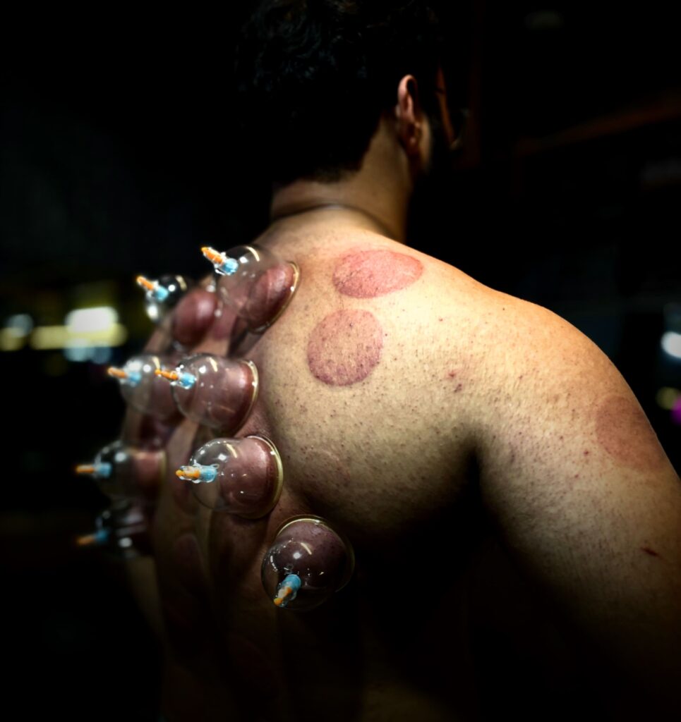 Twelve Meridian cupping therapy for athletes and gym-goers pain relief