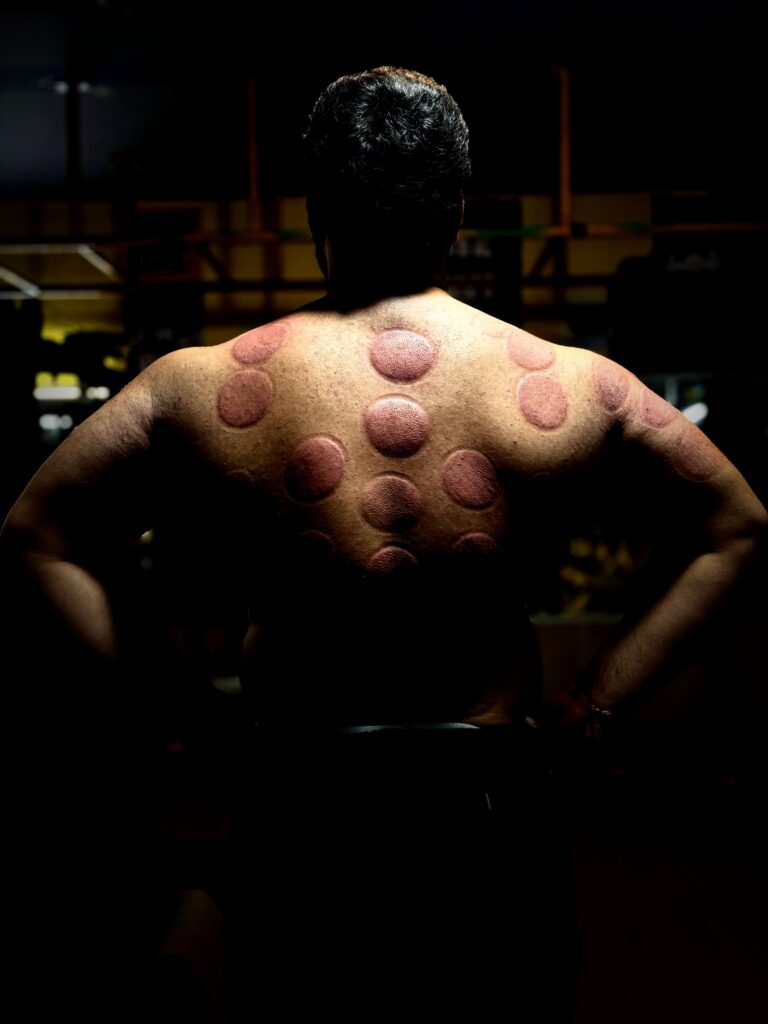 Twelve Meridian cupping therapy for athletes and gym-goers pain relief