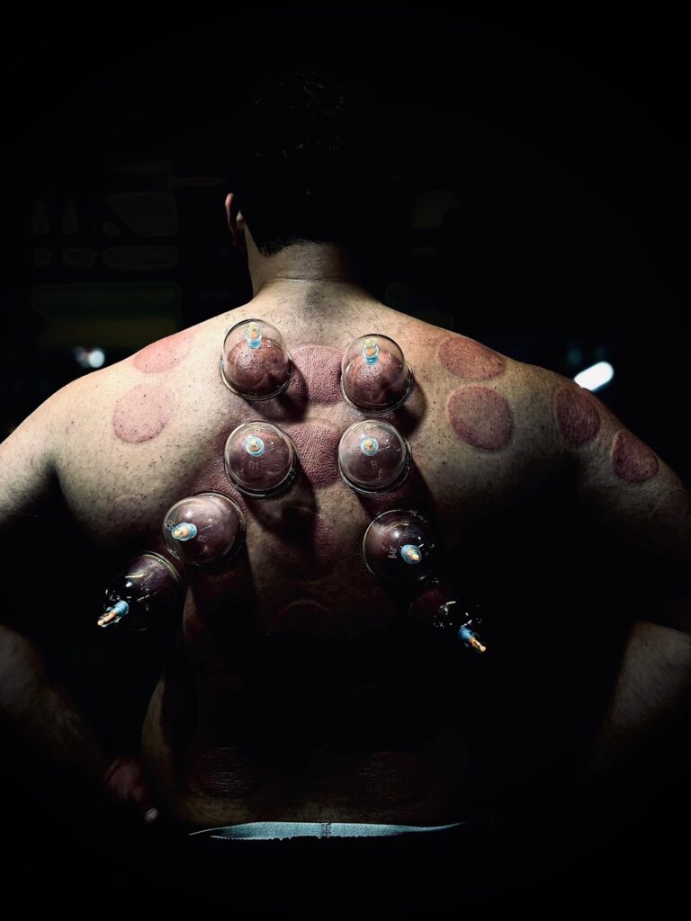 Twelve Meridian cupping therapy for athletes and gym-goers pain relief