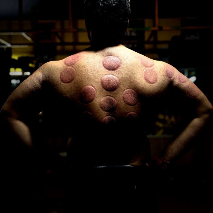 Twelve Meridian cupping therapy for athletes and gym-goers pain relief